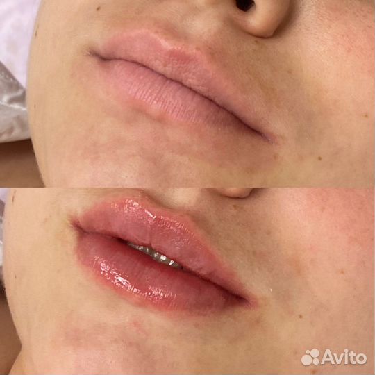 Увеличение губ