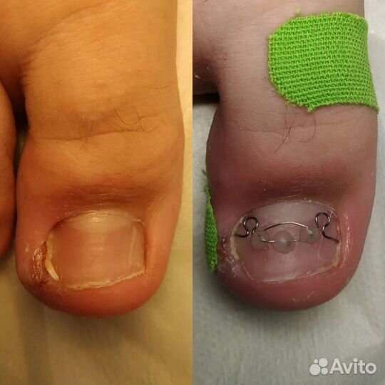 Подолог Самара медицинский педикюр услуги подолога