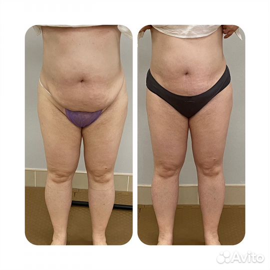 Карамельная липосакция.Аппаратный массаж