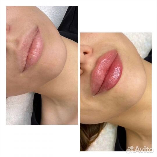 Косметолог/губы/ботокс/Full Face