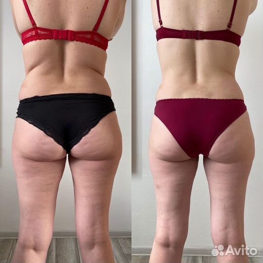 Антицеллюлитный LPG массаж, коррекция фигуры