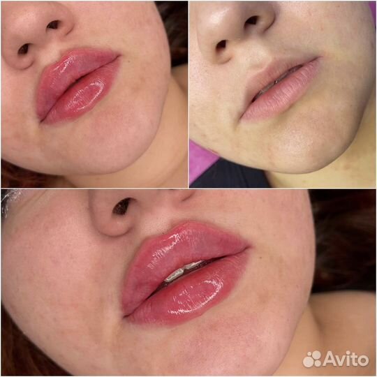 Косметолог/губы/ботокс/Full Face