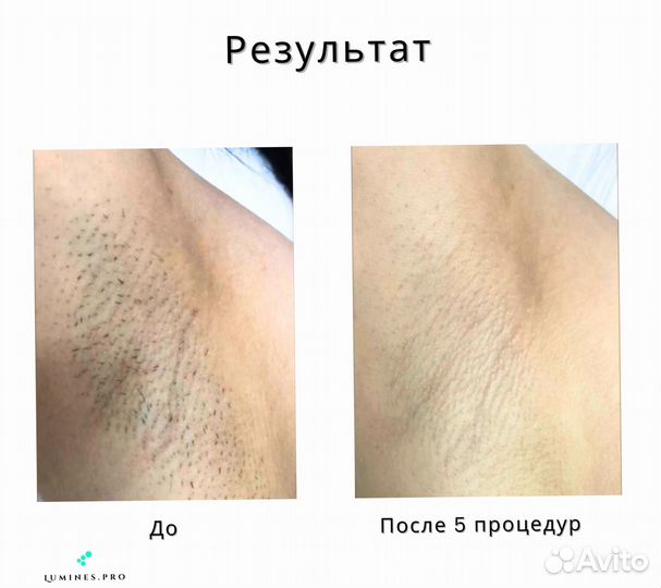 Диодный лазер Lumines Max Plus 2000в