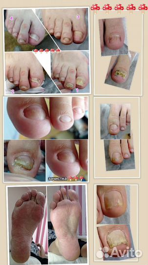 Подолог. Медицинский педикюр