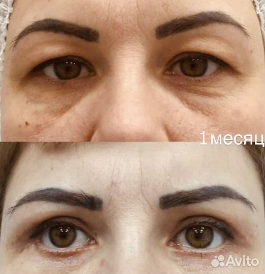 Блефаропластика