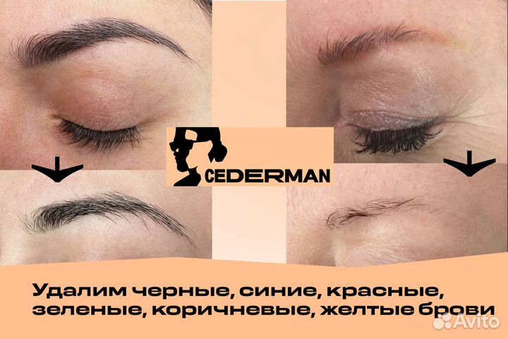 Удаление татуажа