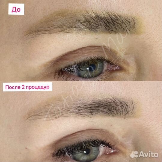 Удаление ремувером татуажа