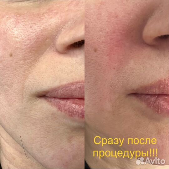 Лечение гипергидроза подмышек