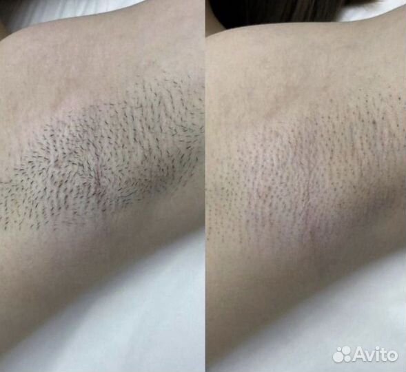 Лазерная эпиляция