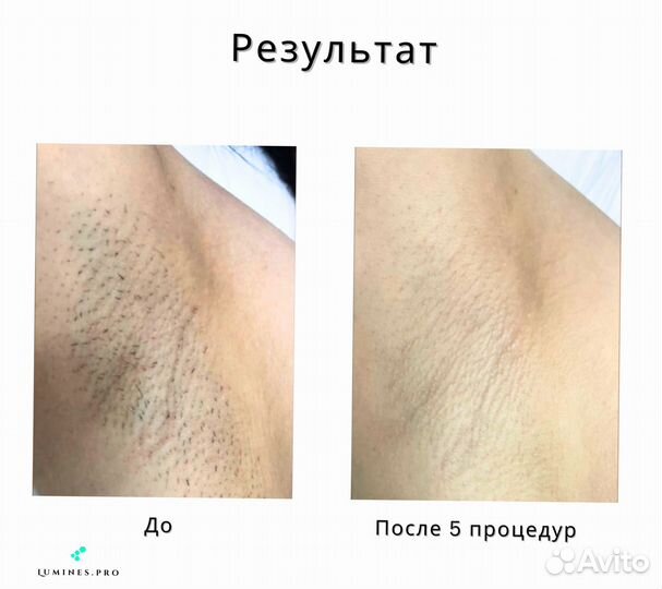 Диодный лазер Lumines’ Max Plus 2000в