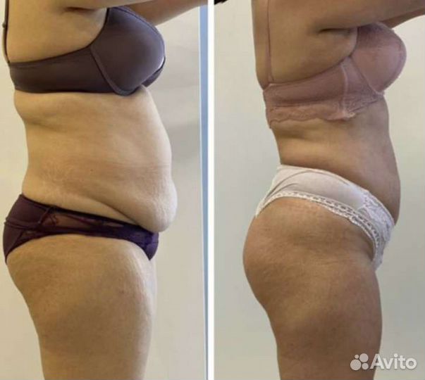 Аппаратный массаж тела EMS скульптор