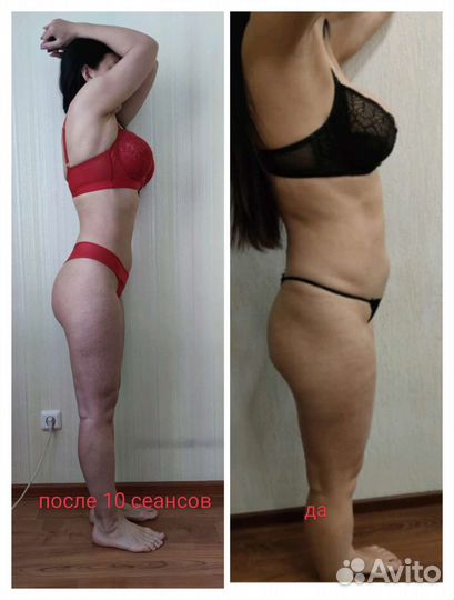 LPG массаж, прессотерапия, миостимуляция