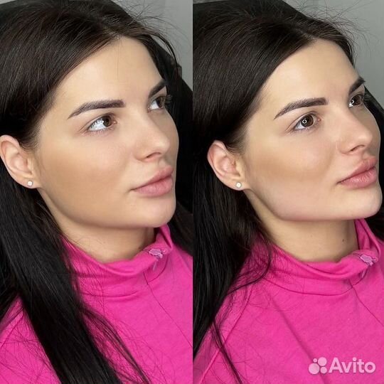 Косметолог: Губы, липолитики, мезотерапия, ботокс