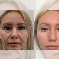 Увеличение губ/фулфейс/ботокс/липолитик/косметолог, Мытищи