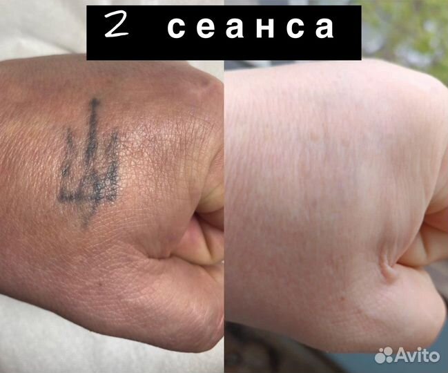 Удаление татуажа и тату