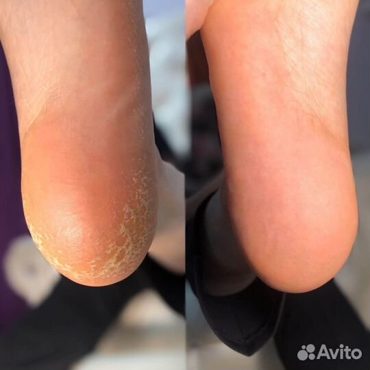 Подолог, коррекция вросшего ногтя, лечение трещин