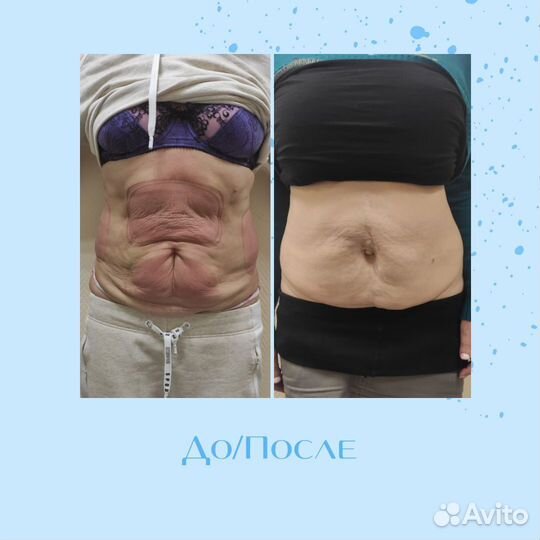 Массаж Коррекция фигуры