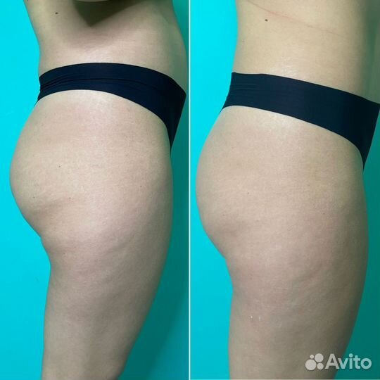 Антицеллюлитный массаж Ручной массаж