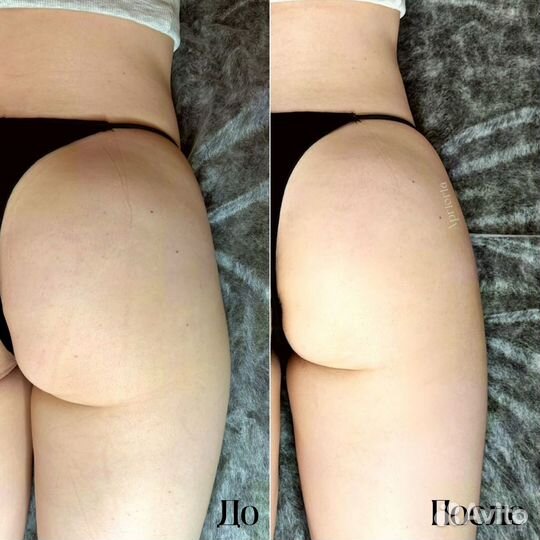 Эндосфера (аналог)массаж