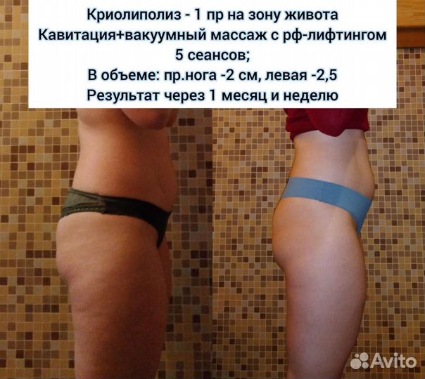 Криолиполиз Массаж Кавитация (коррекция фигуры)
