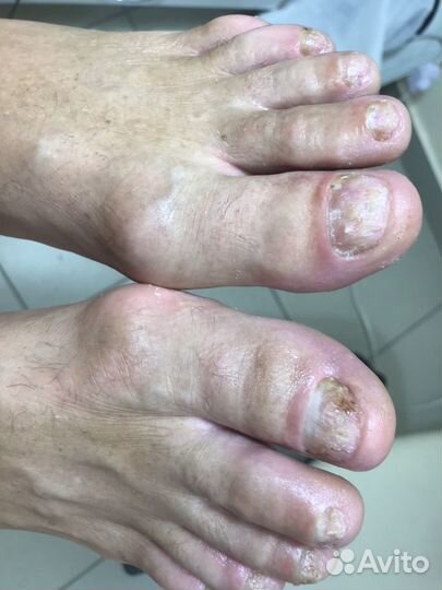 Педикюр для проблемных стоп.Вросший ноготь