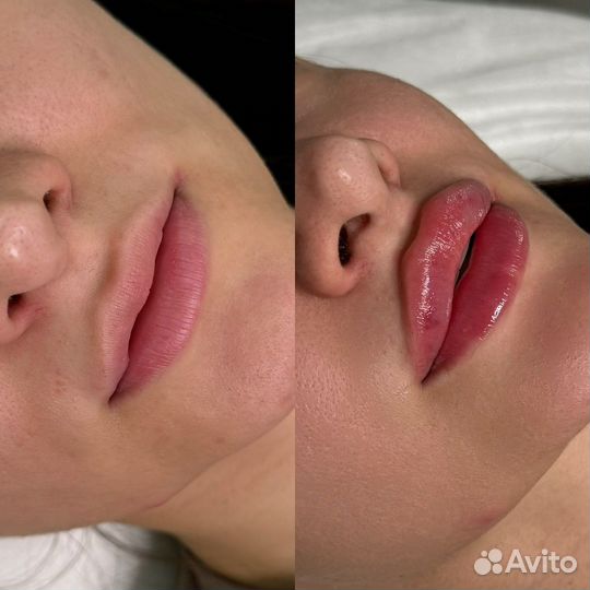 Косметолог: Увеличение губ, контурная пластика