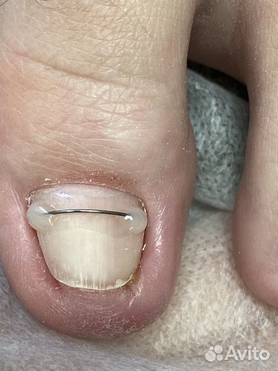 Удаление бородавок на стопах, подолог