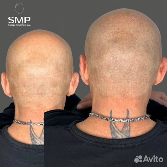 Трихопигментация SMP