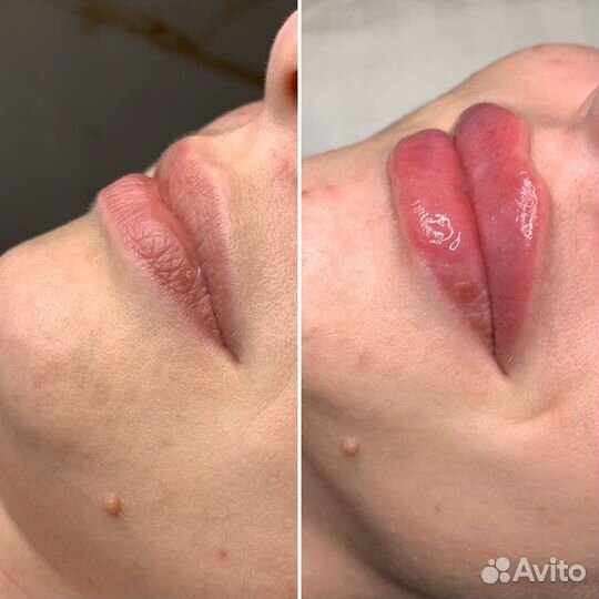 Инъекции, ботокс лица, губ, межбровье, лоб