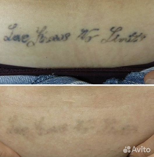 Лазерное удаление тату