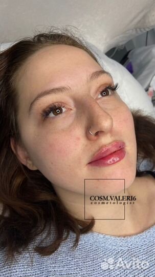 Увеличение губ модель