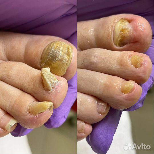 Педикюр подологический (мужской, женский)