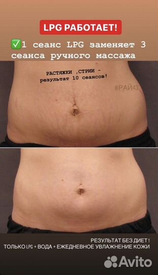LPG.+Массаж.+Инфракрасный разогрев+Кавитация