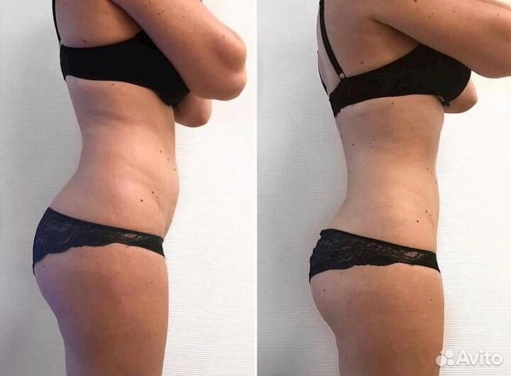 Аппаратный массаж / Вакуумный массаж / Кавитация