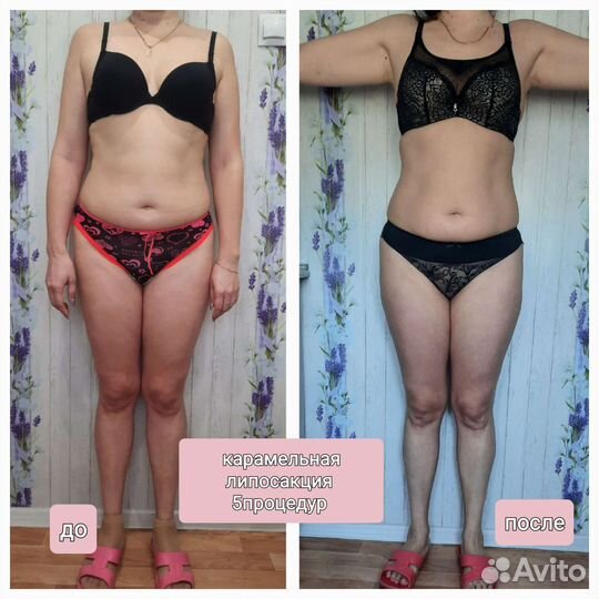 Коррекция фигуры. Липосакция карамельная. Лифтинг