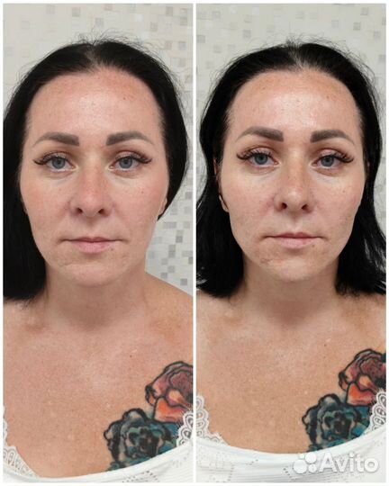 Контурная пластика лица