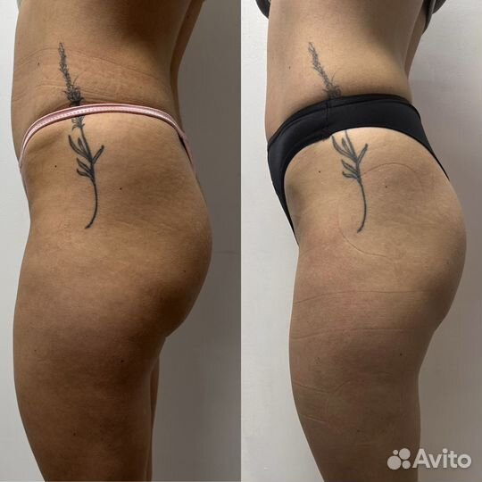 Коррекция фигуры