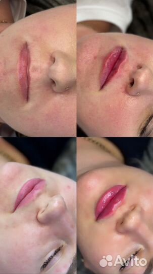 Контурная пластика губ