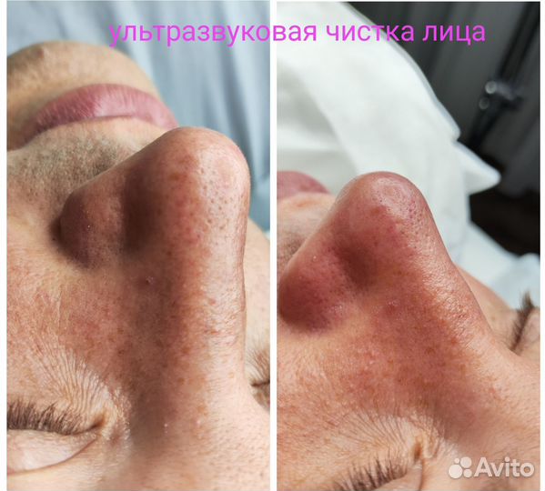 Чистка лица, лифтинг, липосомальный пилинг