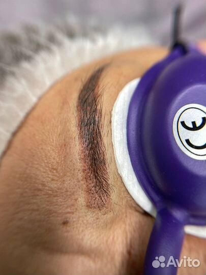 Удаление татуажа