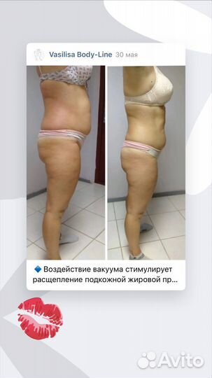 Аппаратный массаж