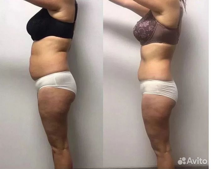 Липосакция без операции в Воронеже