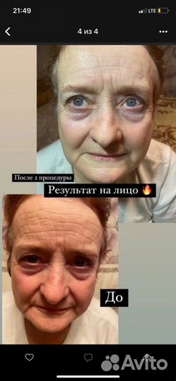 Плазмолифтинг