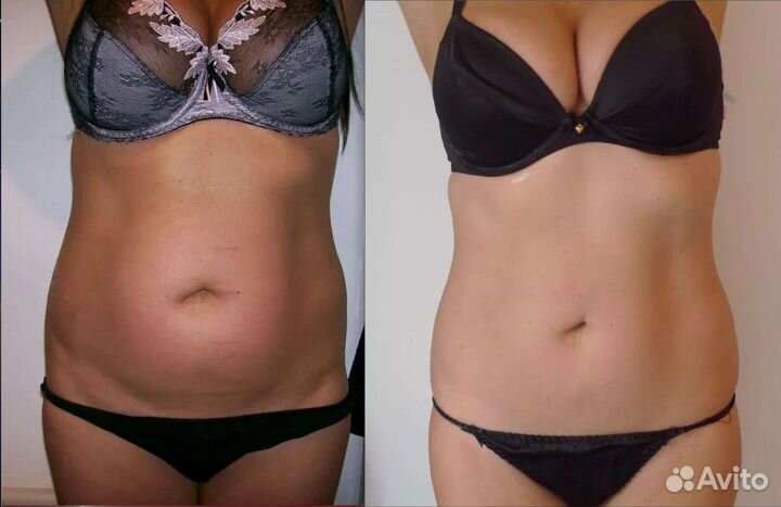 Мгновенное похудение. Липосоникс. Липосакции