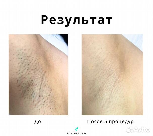 Диодный лазер Lumines-M Макс’Ван 1200W