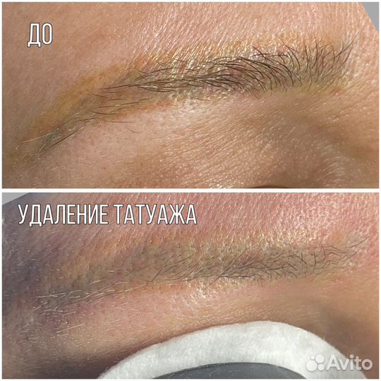 Удаление тату/ татуажа/карбоновый пилинг