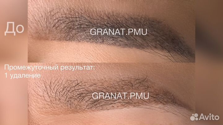 Лазерное удаление перманента и татуажа бровей