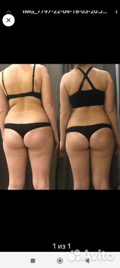 Антицеллюлитный массаж