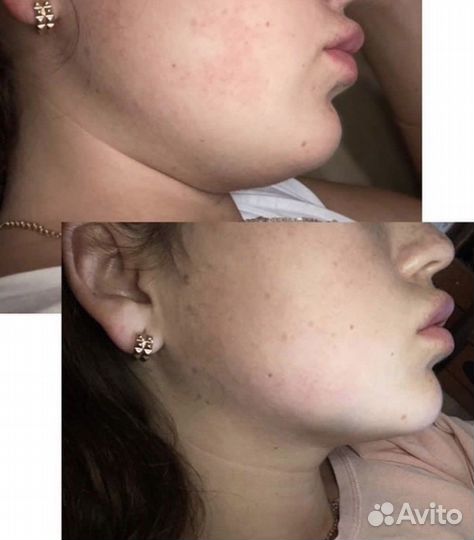 Липолитики