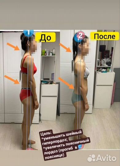 Коррекция осанки, лечение сколиоза, плоскостопие